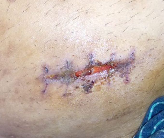 Wound Opening