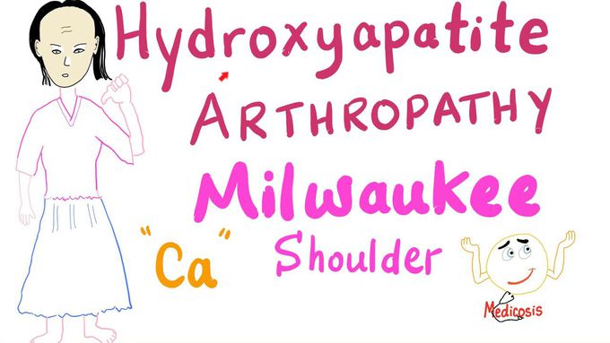 Hydroxyapatite Arthropathy | Milwaukee Soulder
