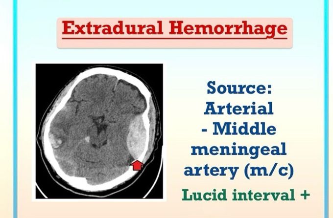 Extradural Hemorrhage