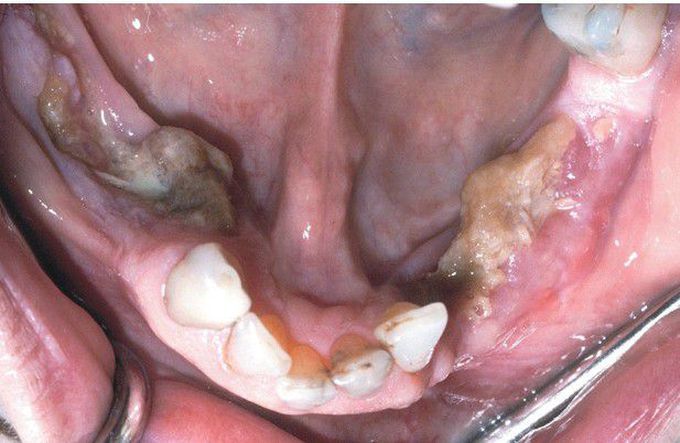 Medication-related Osteonecrosis