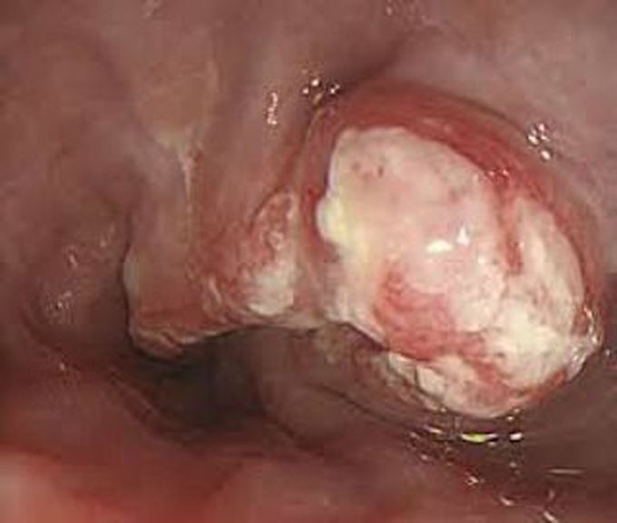 Esophageal Cancer