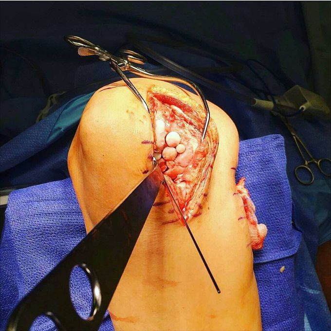 Articular cartilage