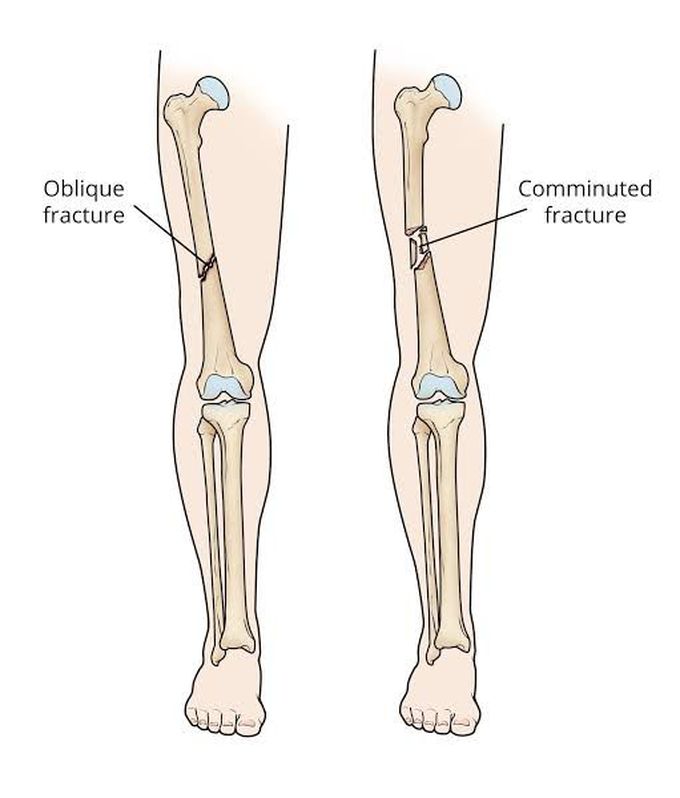 Oblique fracture