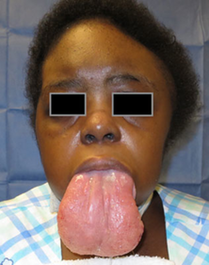 Conditions Causing Macroglossia