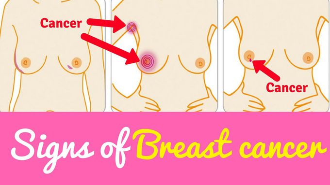 What Are Some Of The Symptoms Of Breast Cancer Everyone Should Know?