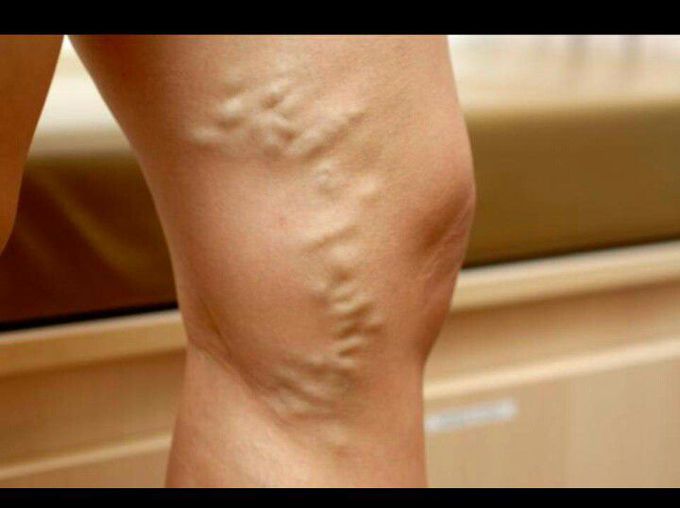 Varicose vein