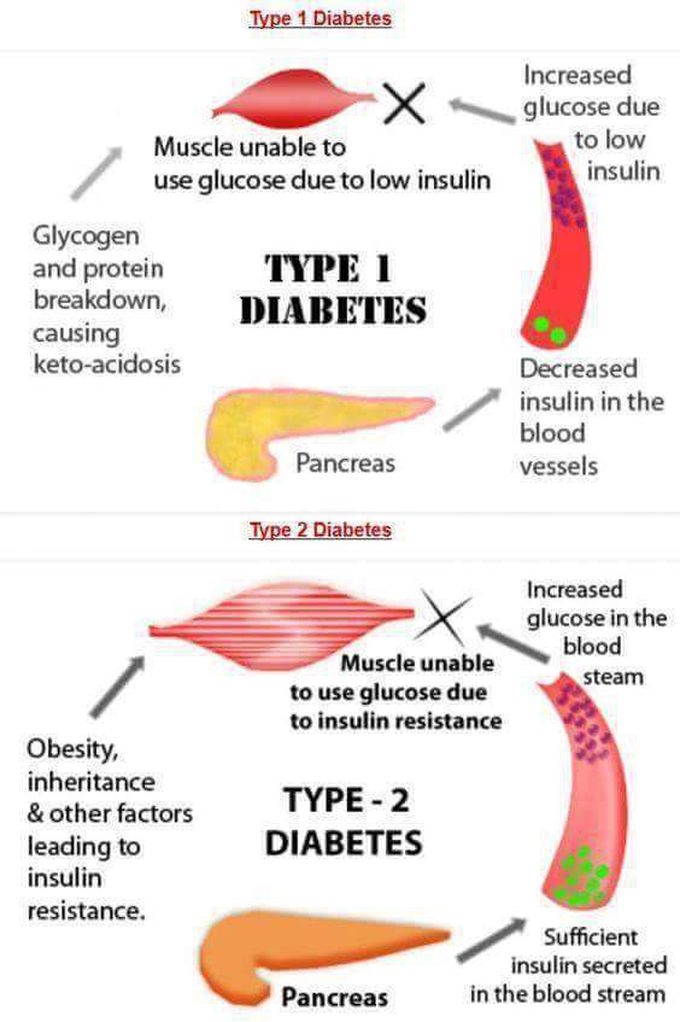 Diabetes