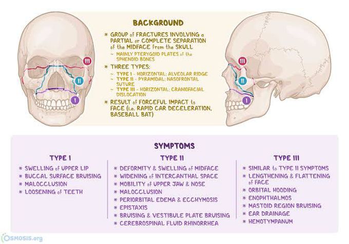 Le Forte Classification