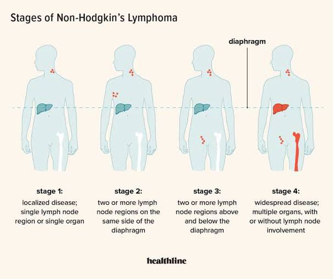 Stages of Non-hodgkin Lymphoma
