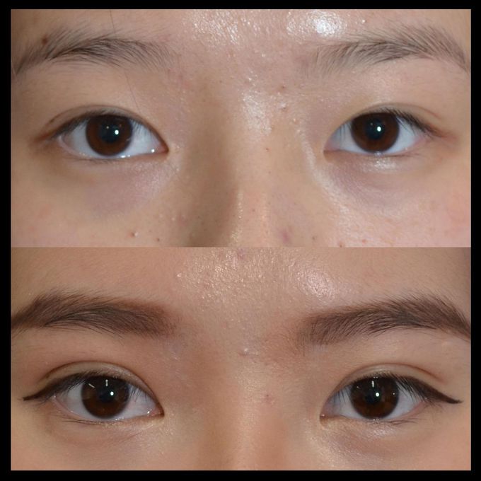 Asian eyelid surgery in Delhi and Gurgaon