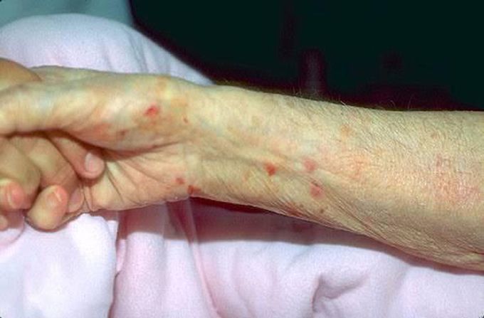 Scabies wrist