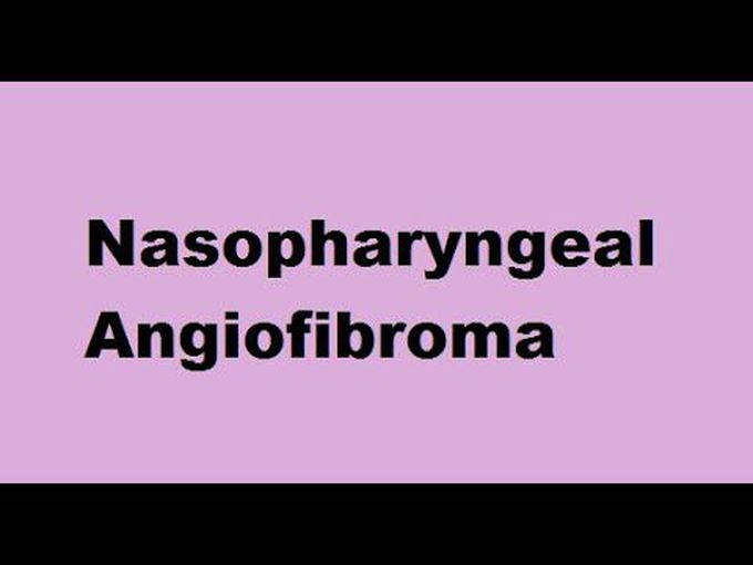 Understanding Nasopharyngeal Angiofibroma