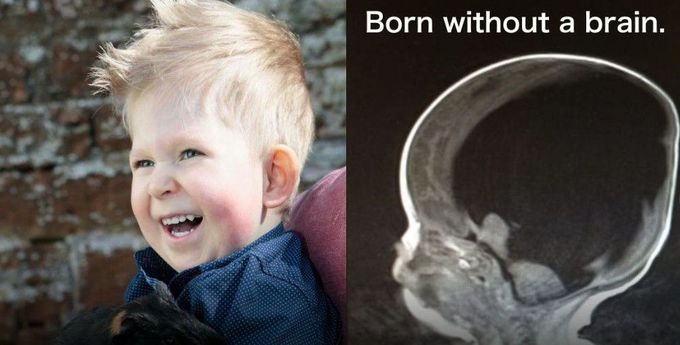 Child born without Brain!!!