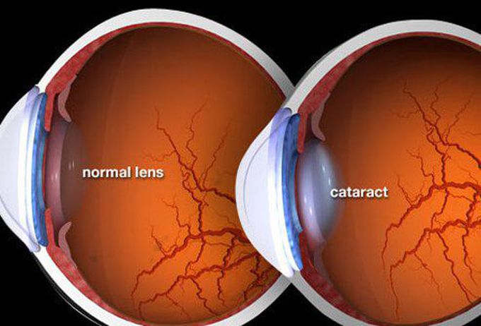 Cataract