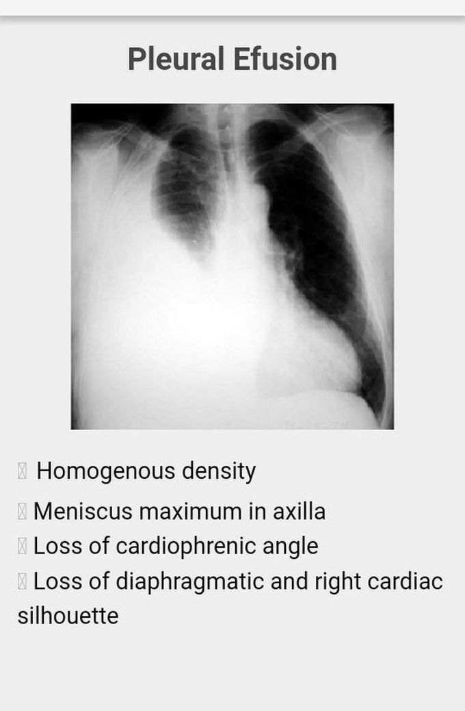 pleural effusion