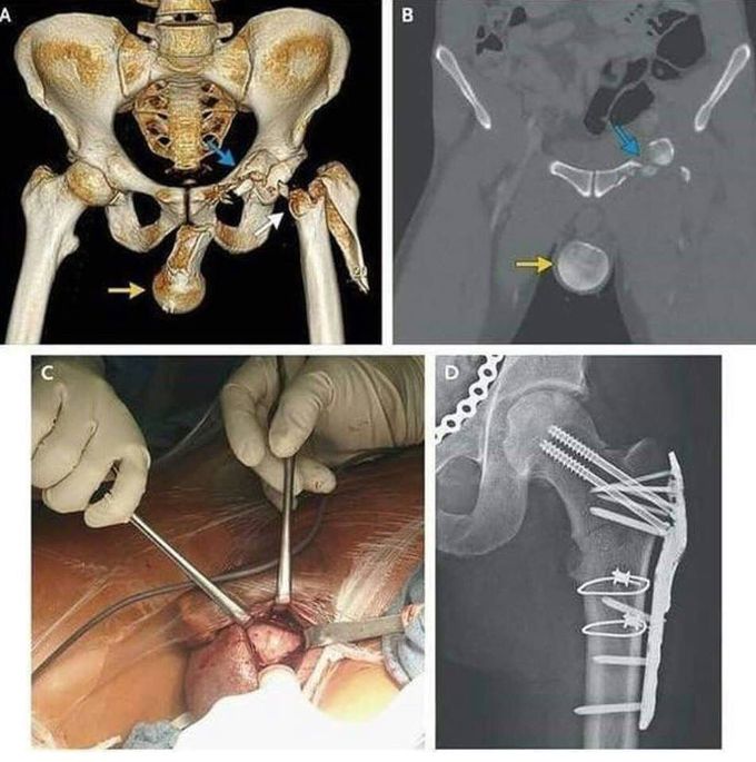 Head of femur in the scrotum!