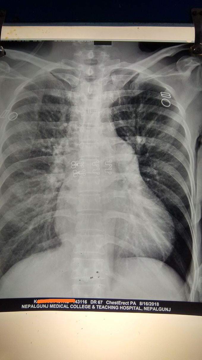 Case of Isolated TR