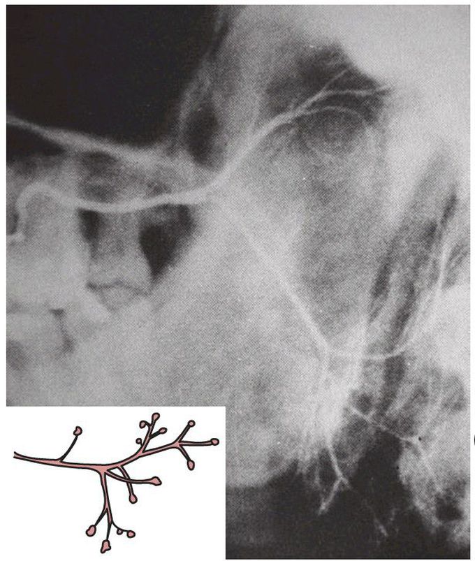 Sialadenitis