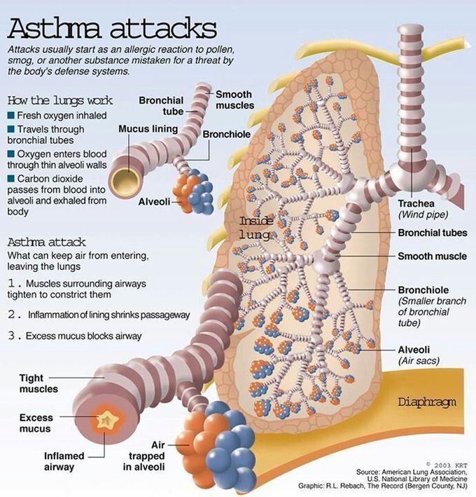 Asthma attack