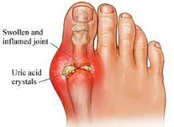 gout causes