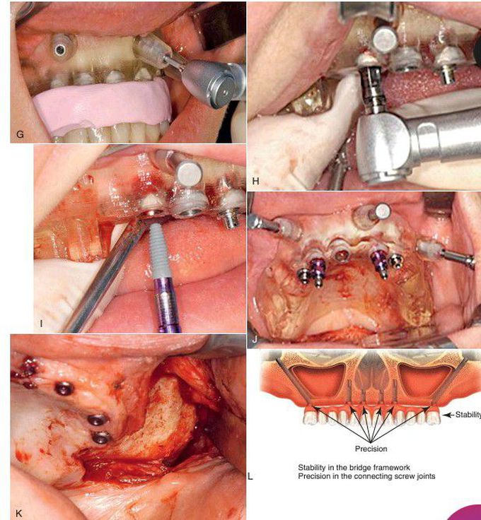 Maxilla rehabilitation