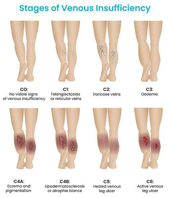 Stages of Venous Insufficiency