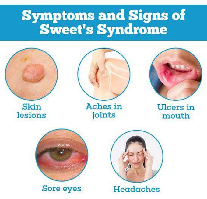 These are the signs and symptoms of Sweets syndrome