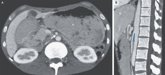 Superior Mesenteric Artery Syndrome