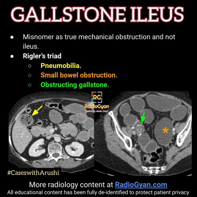 Gallstone Ileus