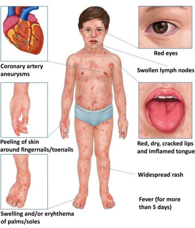 Name this Disease