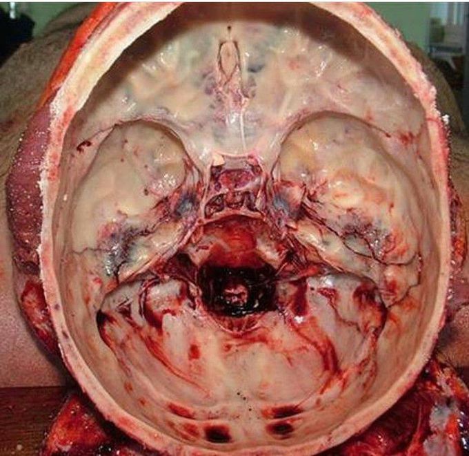 Empty cranium cavity...