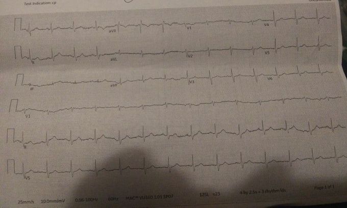 Rhythm strip to ECG