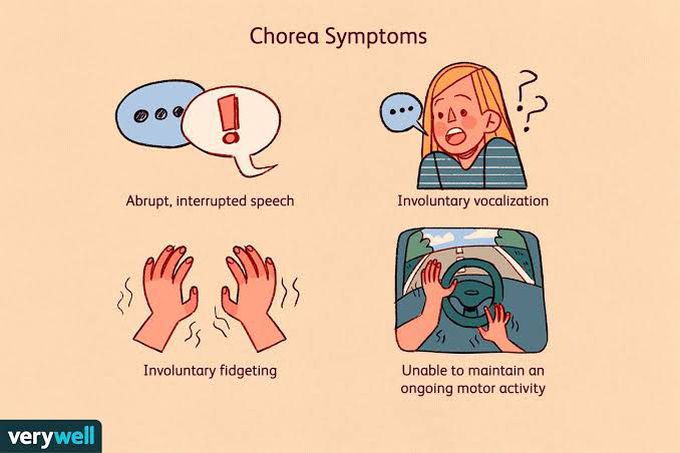 Symptoms of chorea gravidarum