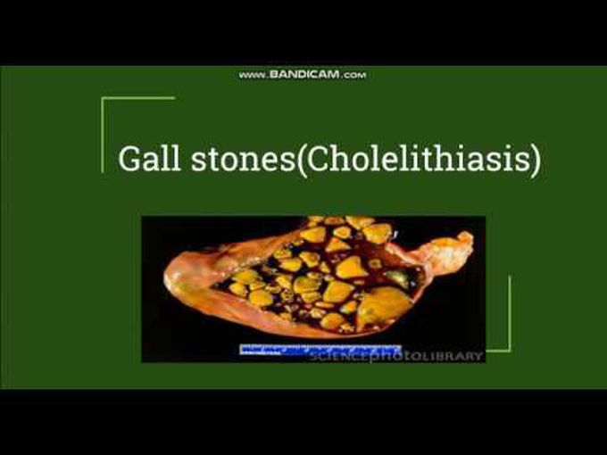 Gallstones-Explained