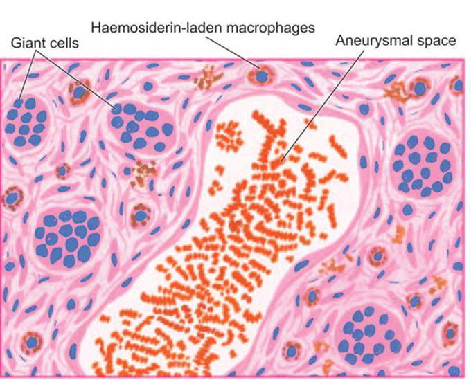 Aneurysmal bone cyst