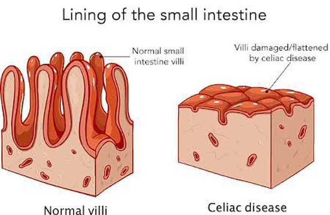 Celiac disease