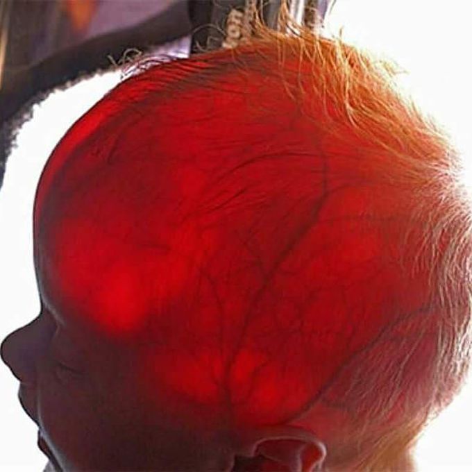 Transillumination of a newborn's head- HYDRANENCEPHALY