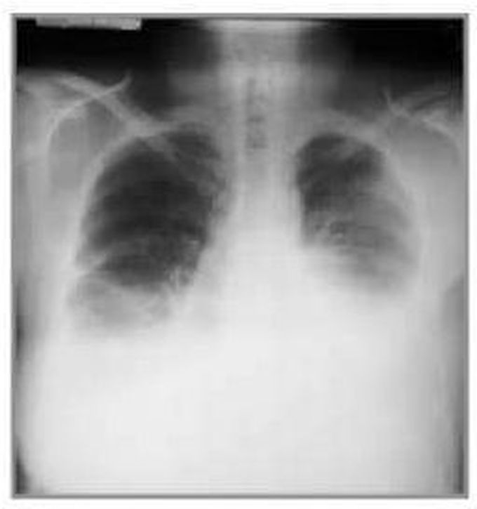 Diagnosis?What diagnostics should be done?