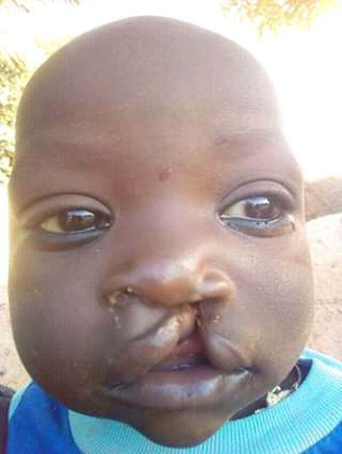 Birth defect in children