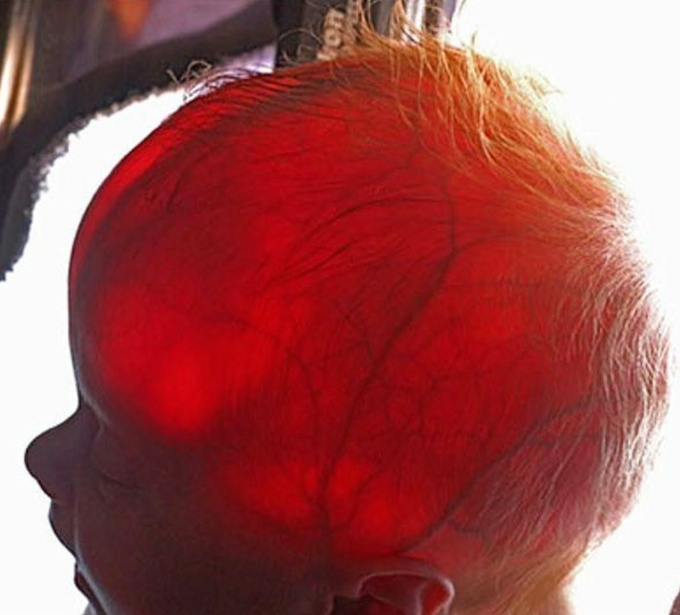 Transillumination of a newborn's head