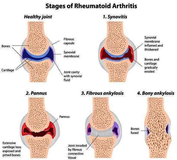 rheumatoid arthritis