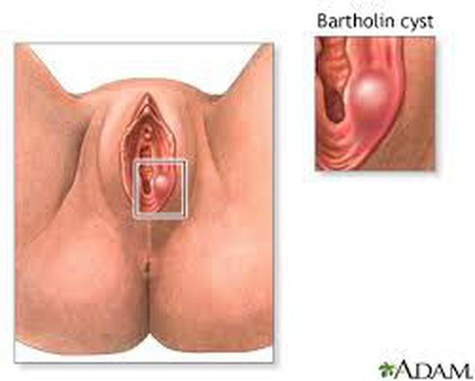 Causes of bartholin cyst