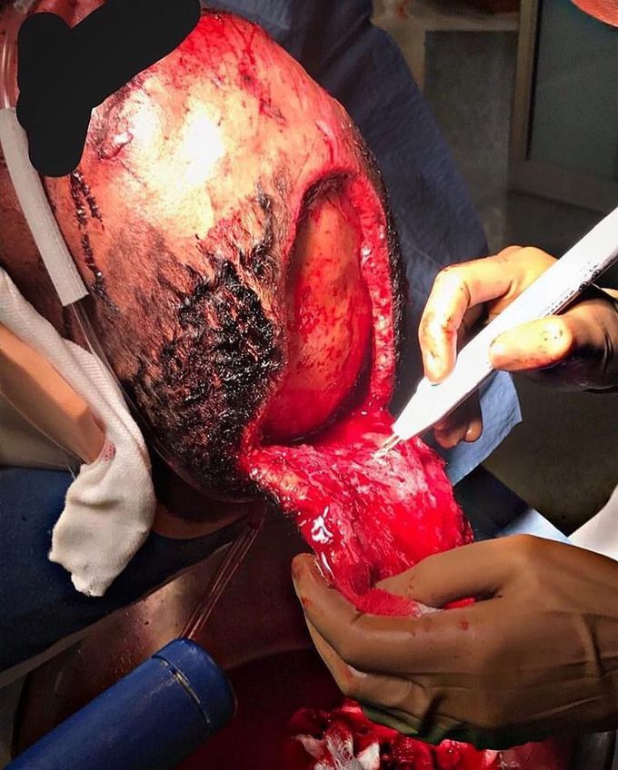  Massive scalp laceration