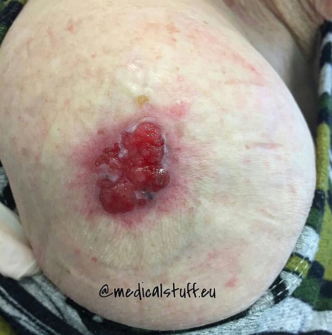 Malignant melanoma, located on the right shoulder