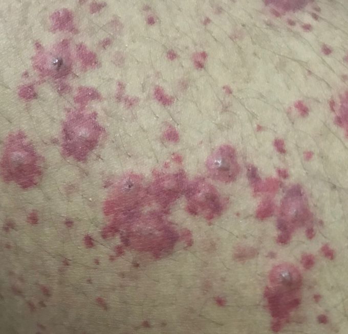 Dx ? Treatment ? Urgent