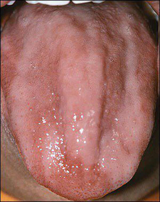 pernicious anemia tongue