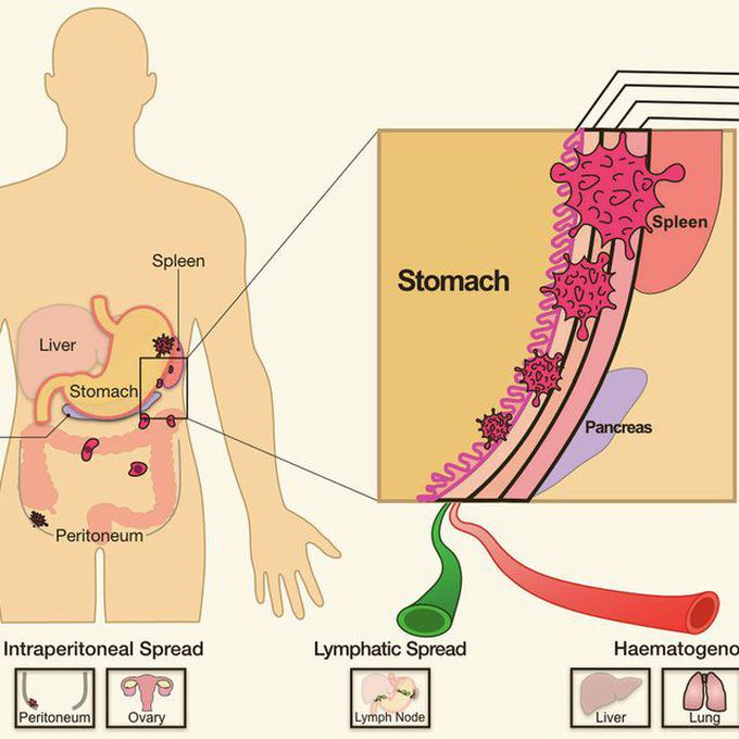 Metastases of Gastric Carcinoma