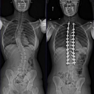 pre-and-post-op-x-rays-of-a-double-curve-scoliosis-both-medizzy