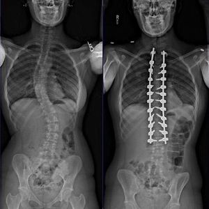 Pre- and Post-op X-rays of a double curve scoliosis (Both - MEDizzy