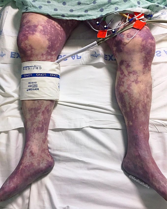 Purpura fulminans in a patient with strep pneumonia bacteremia!!
